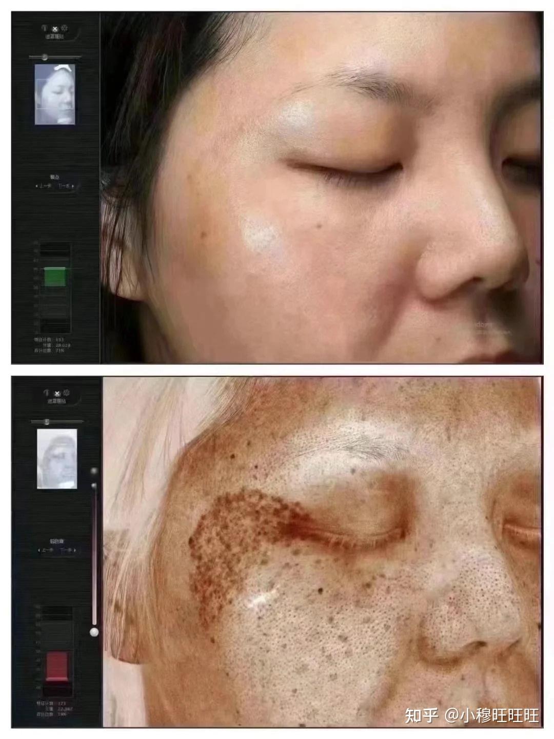 激光祛斑，選擇醫(yī)院還是美容院？全面解讀助您做出明智決策，激光祛斑，如何選擇醫(yī)院與美容院？全面解讀為您指明決策方向