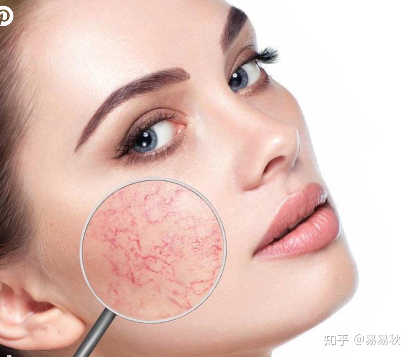 改善面部紅血絲的方法，改善面部紅血絲的有效方法