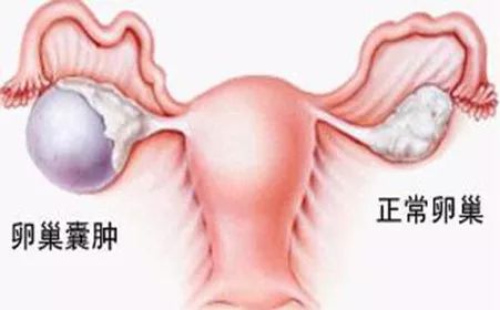 卵巢囊腫的十個征兆，卵巢囊腫的十個征兆解析