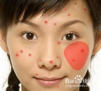 青春期長(zhǎng)痘痘了怎么消除，全面解析與應(yīng)對(duì)方法，青春期痘痘消除全面解析與應(yīng)對(duì)方法指南