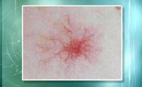 肝癌身上出現(xiàn)紅點圖片，癥狀解析與關(guān)注，肝癌身上紅點解析，癥狀、圖片及關(guān)注重點