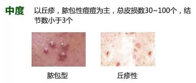 白頭粉刺圖片，了解、預防與應對，白頭粉刺詳解，圖片、預防與應對策略