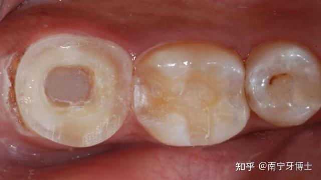 根管治療與牙冠選擇，深入了解，避免誤解，根管治療與牙冠選擇，全面解析，避免誤區(qū)