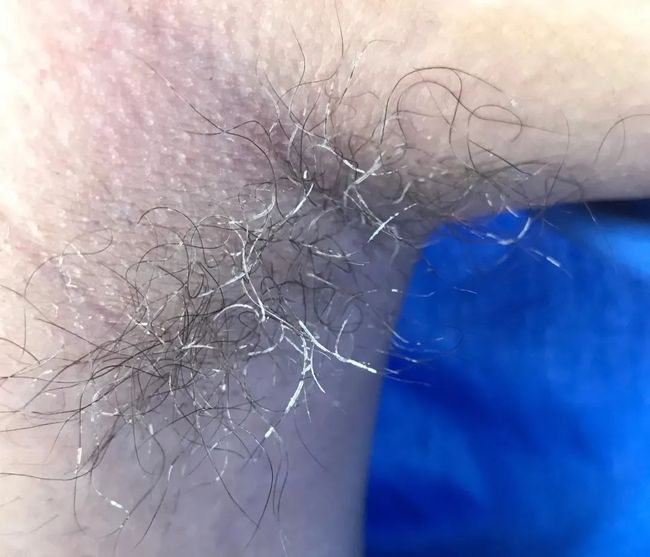 假性狐臭和狐臭的區(qū)別，假性狐臭與狐臭的差異解析