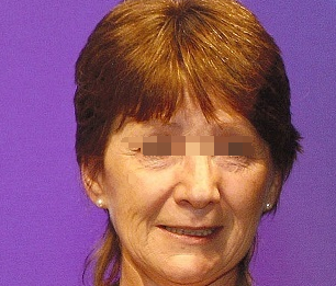 面癱的自我治療方法，面癱自我康復(fù)法，實(shí)用有效的自我治療方法