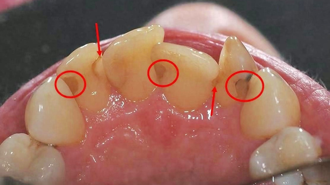 牙結(jié)石怎么去除小竅門，牙結(jié)石去除小妙招分享