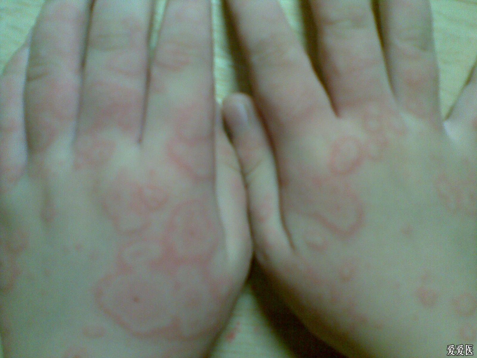 關(guān)于螨蟲過敏圖片與澳彩資料的查詢，來自94848.cσm的詳盡資源，螨蟲過敏圖片與澳彩資料查詢，詳盡資源來自94848.cσm