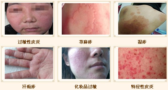 過敏性皮炎治愈方法，全面解析與應對策略，過敏性皮炎全面解析，治愈方法與應對策略