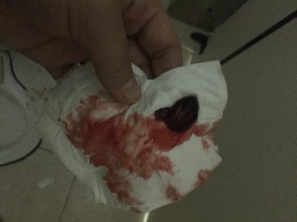 自然流產(chǎn)后的清宮問(wèn)題解析——自己流掉了需要清宮嗎？，自然流產(chǎn)后需清宮嗎？——深度解析清宮問(wèn)題疑慮！