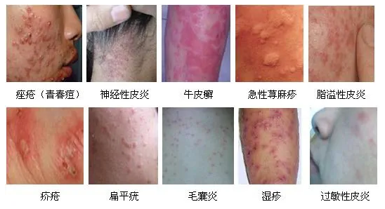 神經(jīng)性皮炎藥物治療指南，探尋最佳用藥方案，神經(jīng)性皮炎藥物治療指南，探尋最佳用藥方案及策略