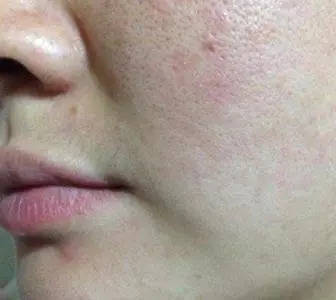 臉上毛孔粗大怎么辦？全方位解決方案助你擁有細(xì)膩肌膚，全方位解決毛孔粗大難題，讓你擁有細(xì)膩肌膚的秘訣！