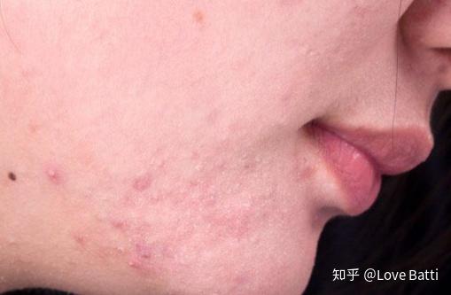 如何判斷臉上是否有螨蟲，全面解析與應(yīng)對(duì)建議，全面解析，如何判斷臉上是否有螨蟲及應(yīng)對(duì)建議