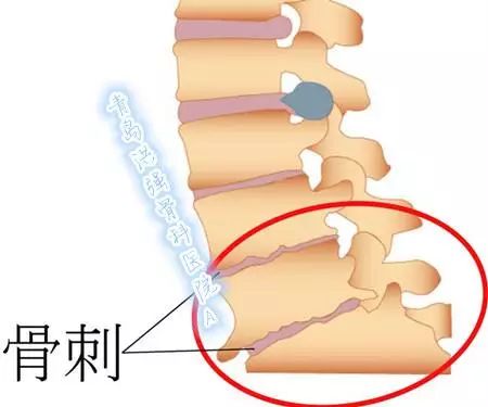 骨刺的最佳治療方法，骨刺的最佳治療方法解析