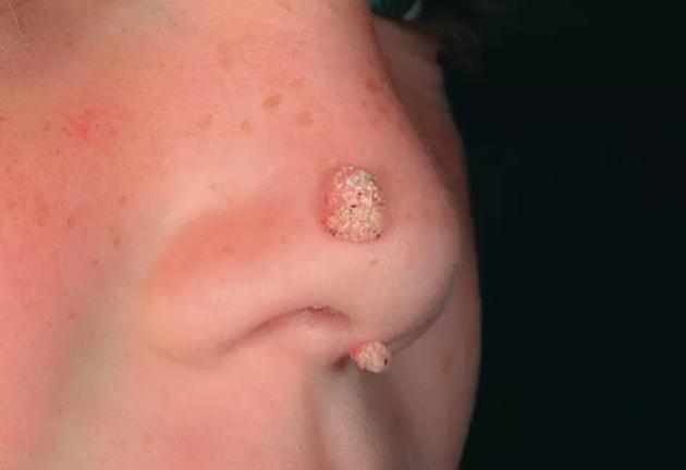 如何判斷是否為雞眼——全面解析雞眼癥狀與診斷方法，雞眼癥狀詳解，診斷方法與判斷指南