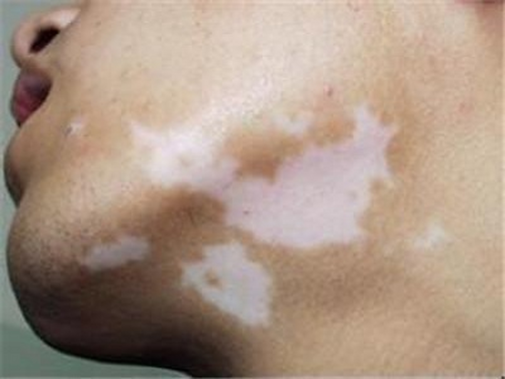 白點癲風怎么治療效果最好，全面解析最佳治療方案，全面解析白點癲風最佳治療方案，治療效果最大化