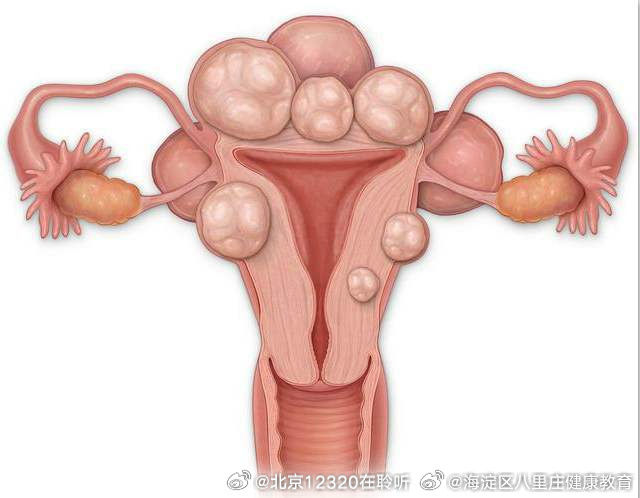 子宮肌瘤的最佳治療方法，全面解析與指導(dǎo)，子宮肌瘤的最佳治療方法詳解與指導(dǎo)手冊(cè)