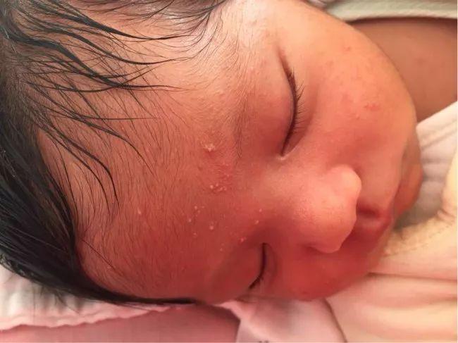 脂溢性皮炎的治療方法，全面解析最佳策略，脂溢性皮炎全面解析最佳治療方法策略