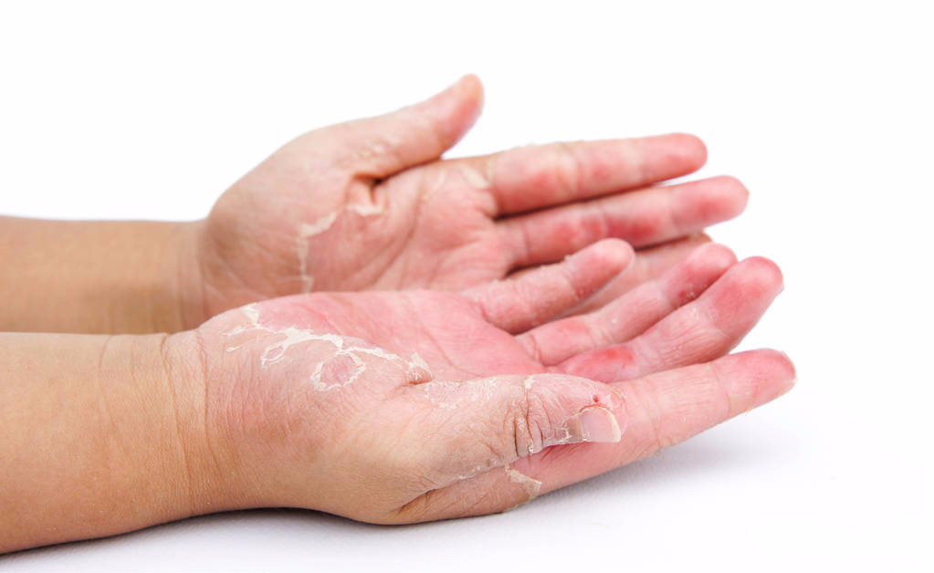 皰疹最佳治療方法，全面解析與個(gè)性化護(hù)理策略，皰疹最佳治療方法詳解，全面解析與個(gè)性化護(hù)理策略