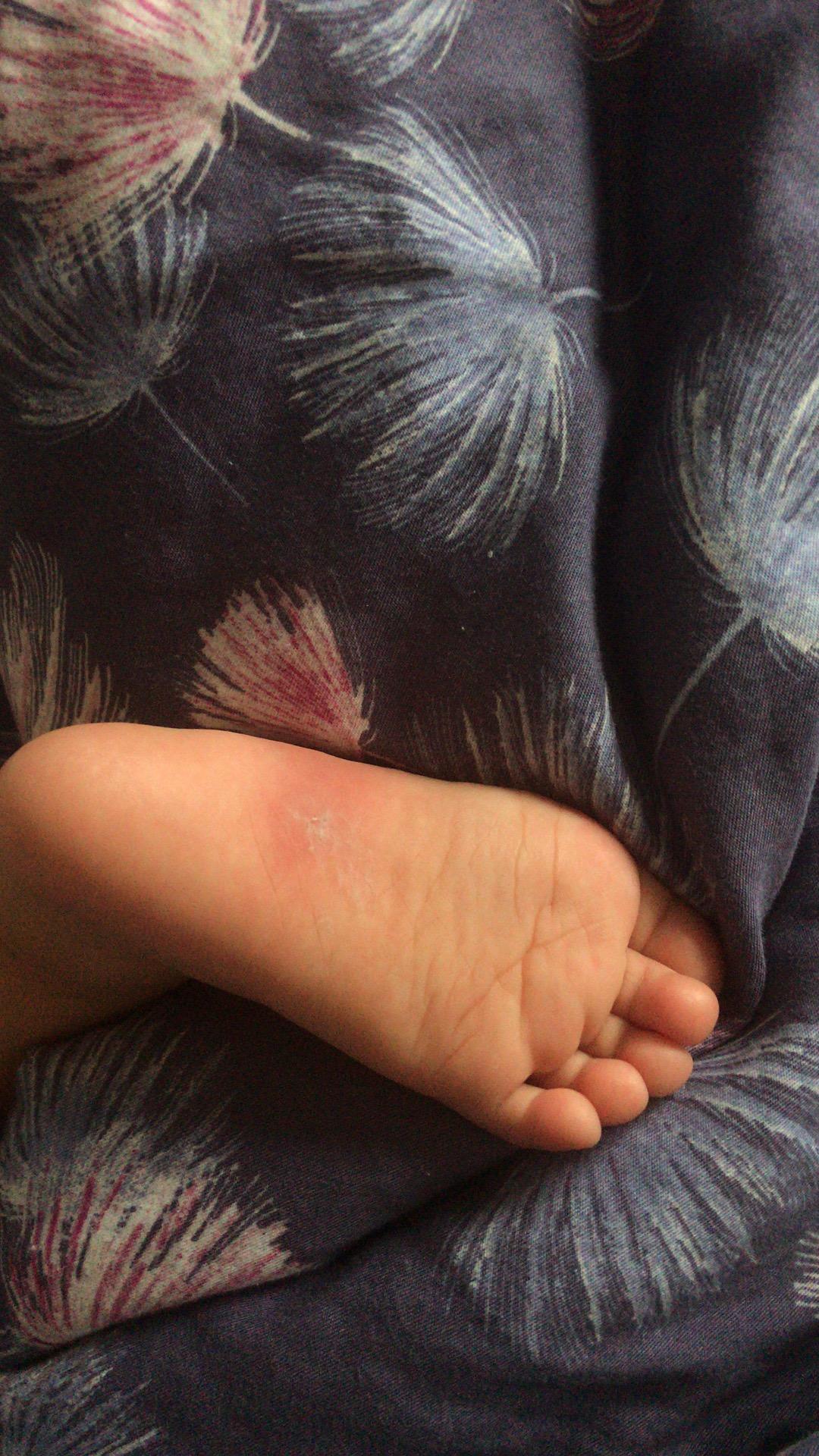 揭秘蚊子喜歡咬的八類人，揭秘蚊子偏愛的八類人群